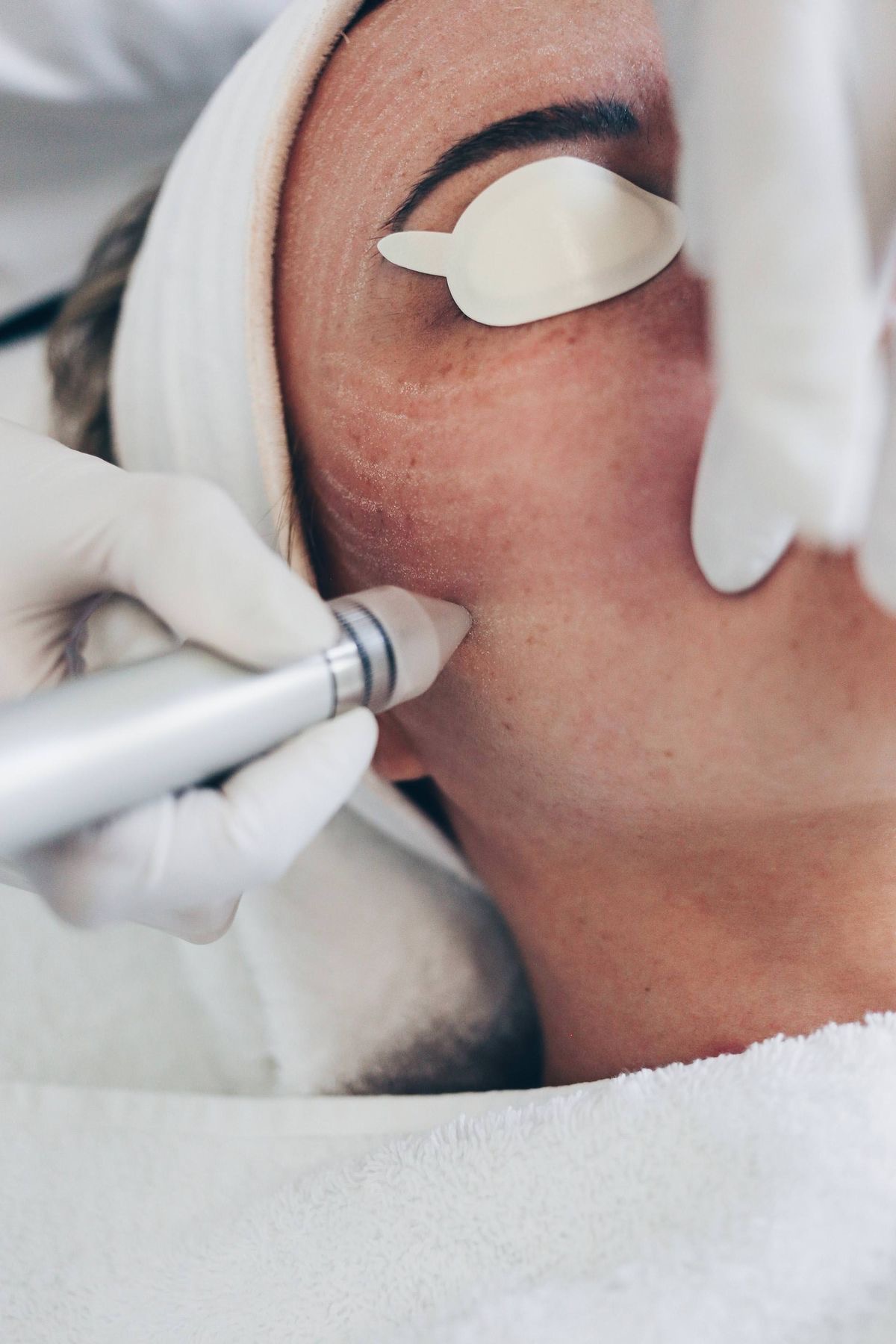 Microdermabrasion